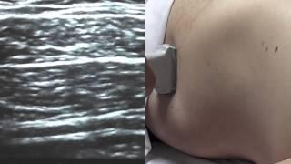 Ultrasound Guided Transversus Abdominis (TAP) - SSRAUSA.com