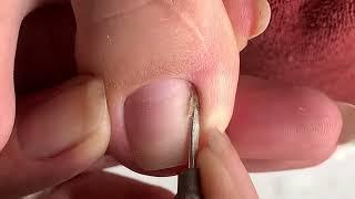 Clean the Skin and remove the corner of the nail#433