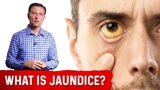 Jaundice Symptoms Explained by Dr.Berg (In Very Simple Terms!!)