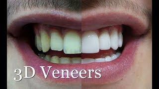 3D Veneers, get a beauty smile without damaging your teeth!!