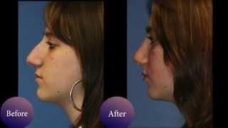 Nose job before & after photos of NYC patients