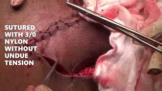 pilonidal sinus excision +Limberg flap13072024