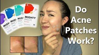 DO ACNE PATCHES REALLY WORK? In Depth Test & Science-Based Review