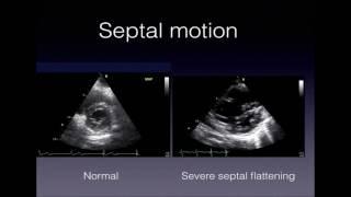 To treat or not to treat right heart failure: that is the question - Micah Fisher, MD