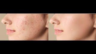 Remove Acne and pimples quickly in photoshop