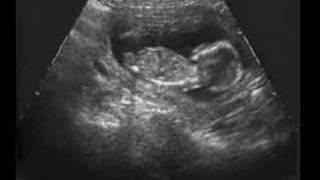 Ultrasound Fetal Response To Alcohol Fetal Alcohol Syndrome