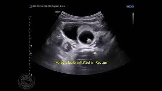 Hydrostatic reduction of Intussusception