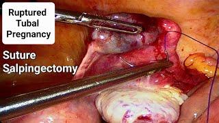 Ectopic Pregnancy | Ruptured Tubal Pregnancy | Laparoscopic Salpingectomy - Dr Tayyab Riaz Ch