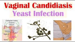 Vaginal Candidiasis (“Yeast Infection”) Causes, Risk Factors, Signs & Symptoms, Diagnosis, Treatment