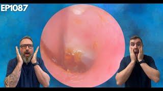 TOUGH CHILDRENS EAR WAX REMOVAL - IT TOOK 2 VISITS - EP1087