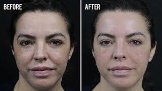 Nose-to-Mouth Treatment | Before & After | SkinViva