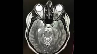 MRI of cancer tumour, I lost my eye to sarcoma cancer. Before and after scans. How I found my tumour