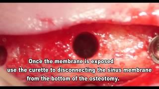 Safe Sinus Lift Kit Surgery Instructions - MSDI dental implanst