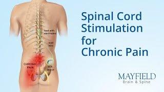 Spinal Cord Stimulation for Chronic Pain