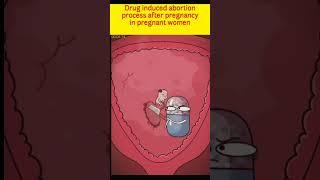 Drug induced abortion process after pregnancy in pregnant women #asmr #shorts