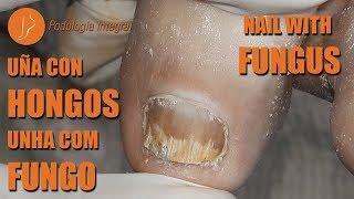 Toenail with fungus [Podología Integral] #podologiaintegral