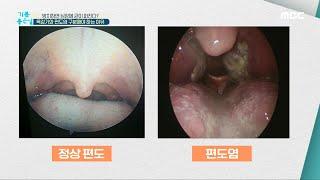 [기분 좋은 날] 목감기와 편도염 구분해야 하는 이유 20200522