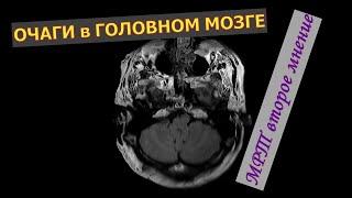 Множественные ОЧАГИ ГОЛОВНОГО МОЗГА на МРТ расшифровке второе мнение МРТ головы