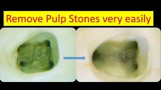 Remove pulp Stones very easily by simple technique and tools