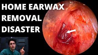 Home Earwax Removal Eardrum Perforation
