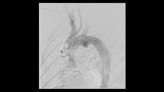 Physician Modified Fenestrated TEVAR for traumatic aortic aneurysm with Bovine Arch (Zone 0 Landing)