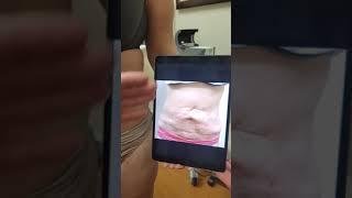 Abdominoplasty/ Tummy Tuck repair by Dr. Franklin Rose after surgery elsewhere