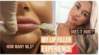 MY LIP FILLER EXPERIENCE AND Q&A // CHARLEEN MURPHY