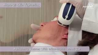 MeDioStar NeXT PRO - Training video for skin rejuvenation and whitening from Asclepion