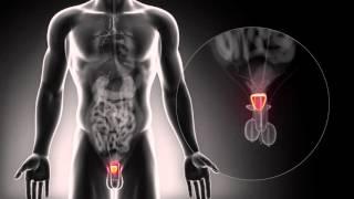 Treatment Options for Localized Prostate Cancer - Urology Care Foundation