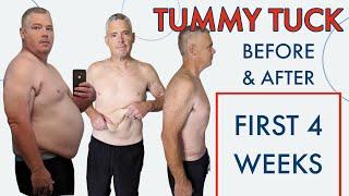 Skin Removal After Extreme Weight Loss 100+ Pounds | Tummy Tuck | Abdominoplasty