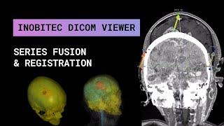 Series fusion and registration with Inobitec DICOM Viewer