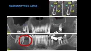 Хирургические и ортопедические этапы восстановления зубного ряда.