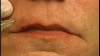 How To Fill Lip Lines (Smokers' Lines) With Dermal Filler