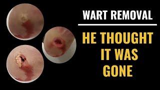 Wart Removal - He thought it was gone