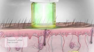 Gentle Hair Removal biological animation