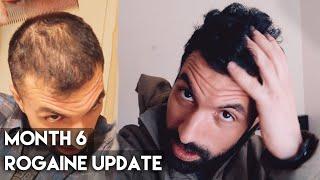 6 Month Rogaine Results (Minoxidil)