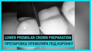 Lower premolar crown preparation. Препаровка нижнего премоляра под коронку.