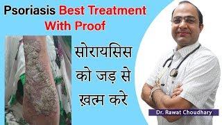 सोरायसिस का पूरा इलाज | Psoriasis Best Homeopathic Treatment | Best Homeopathic Doctor in India