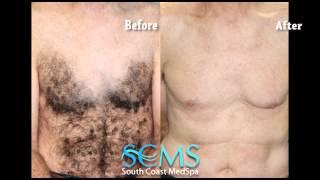 Newport Beach Laser Hair Removal Chest and Abs (Before/After)