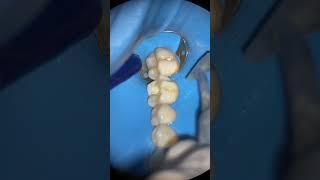 Tooth Decay and Composites Removal via Air Particle Abrasion for Direct #composite #restorations