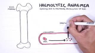 Haemolytic Anaemia - classification (intravascular, extravascular), pathophysiology, investigations