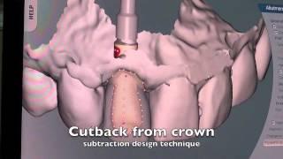 ASC Abutment - How it works? Dental Implant