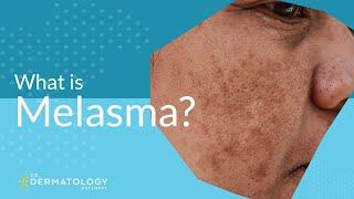 What is Melasma? | Melasma Treatment Explained