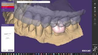 Basic single crown design with Exocad