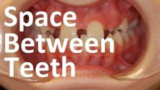 Causes & Orthotropics Treatment of Gaps Between Teeth (Diastema) by Prof John Mew