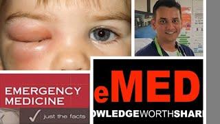 EM Facts for the Boards Part 6 Eyelid Swelling Orbital Cellulitis #MBBS #Ophthalmology #FRCEM #ABEM