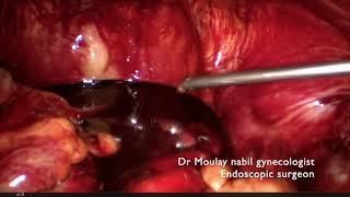 Emergency salpingectomy for ectopic pregnancy