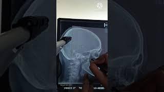 Cephalometrics tracing: demonstration I Dr.Hassan Rasheed