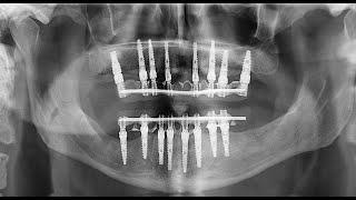 Full mouth reconstruction using Noris Medical implants system | by Prof. Ziv Mazor, Periodontist