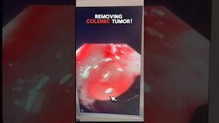 Expert Insights on Removing Colonic Tumor | Dr. Nivedita Pandey #science #endoscopicspinesurgery